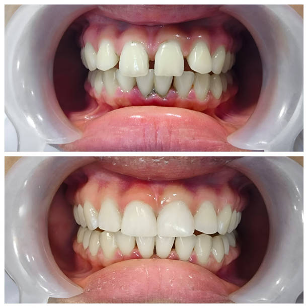 Best Full Mouth Reconstruction  in Atkins, AR